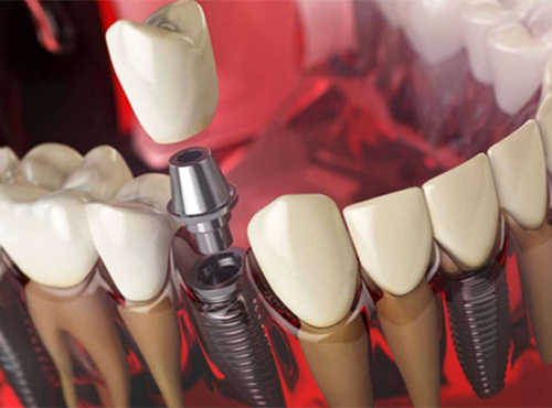 implant